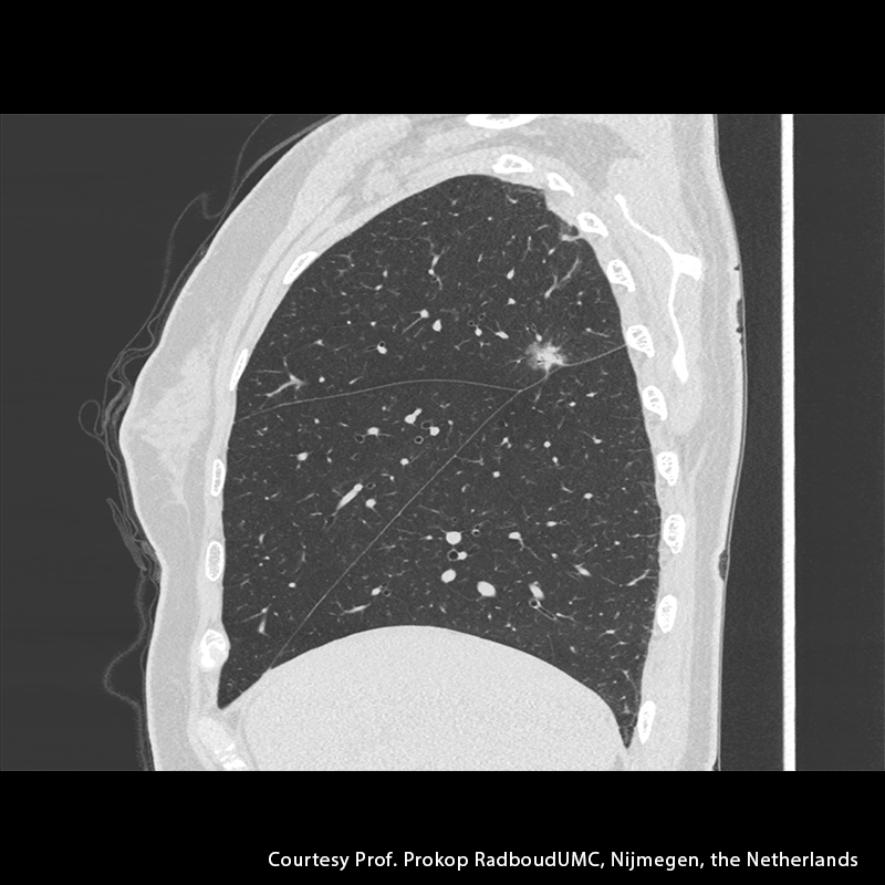 Aquilion Precision Lung
