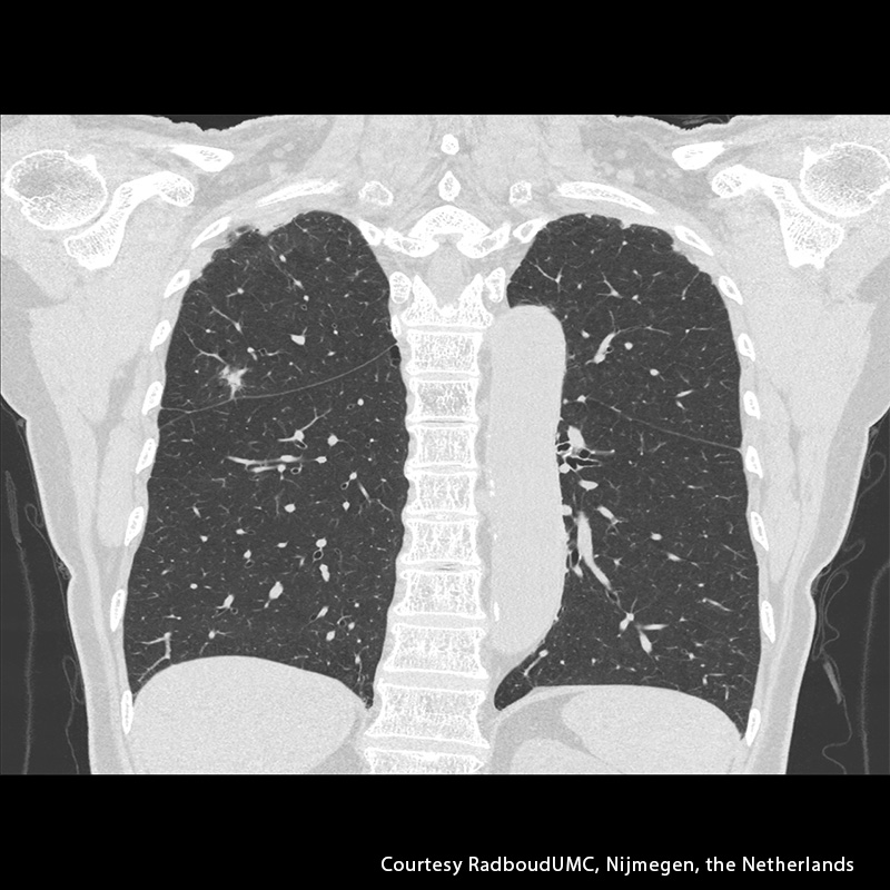 Aquilion Precision Lung