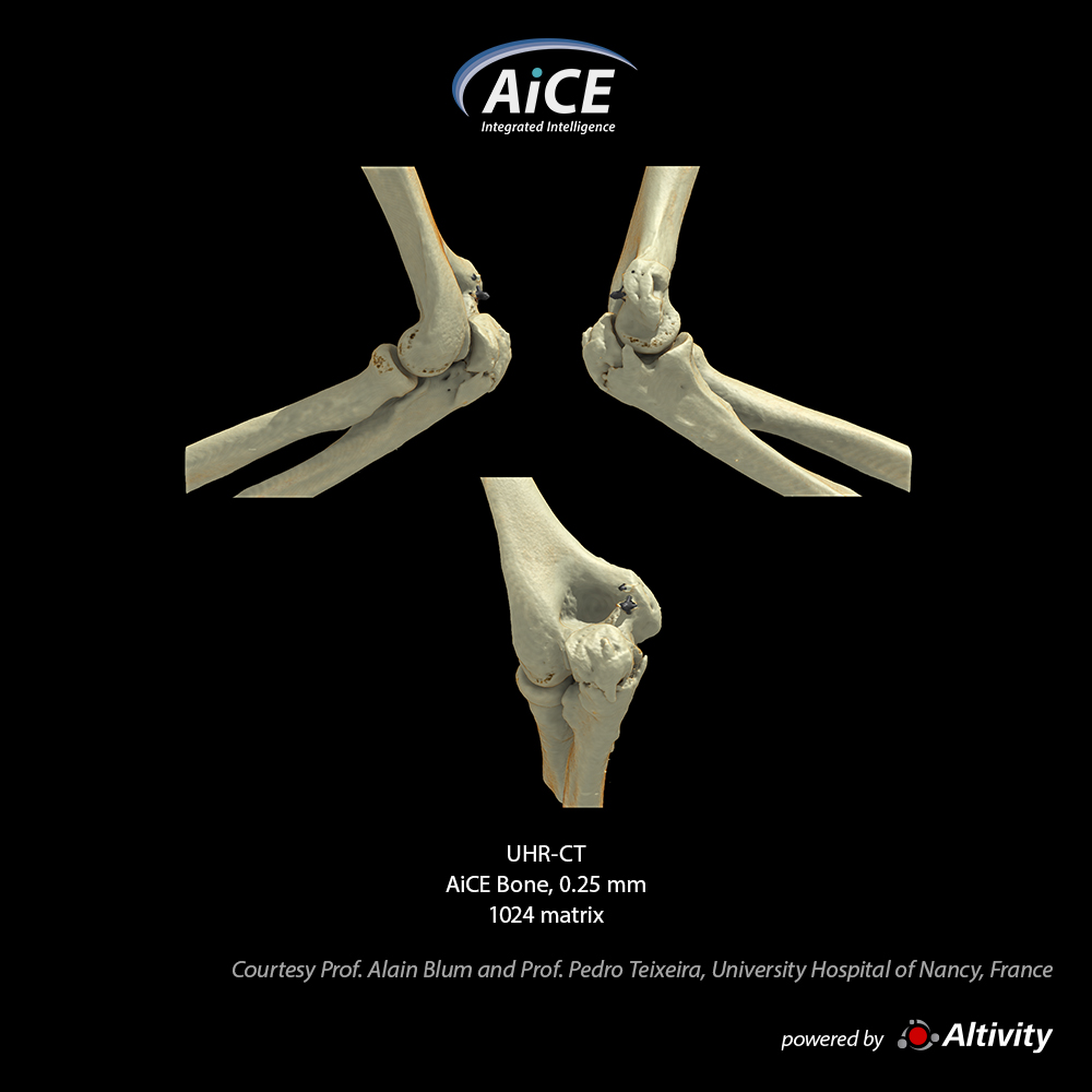 Aquilion Precision Elbow