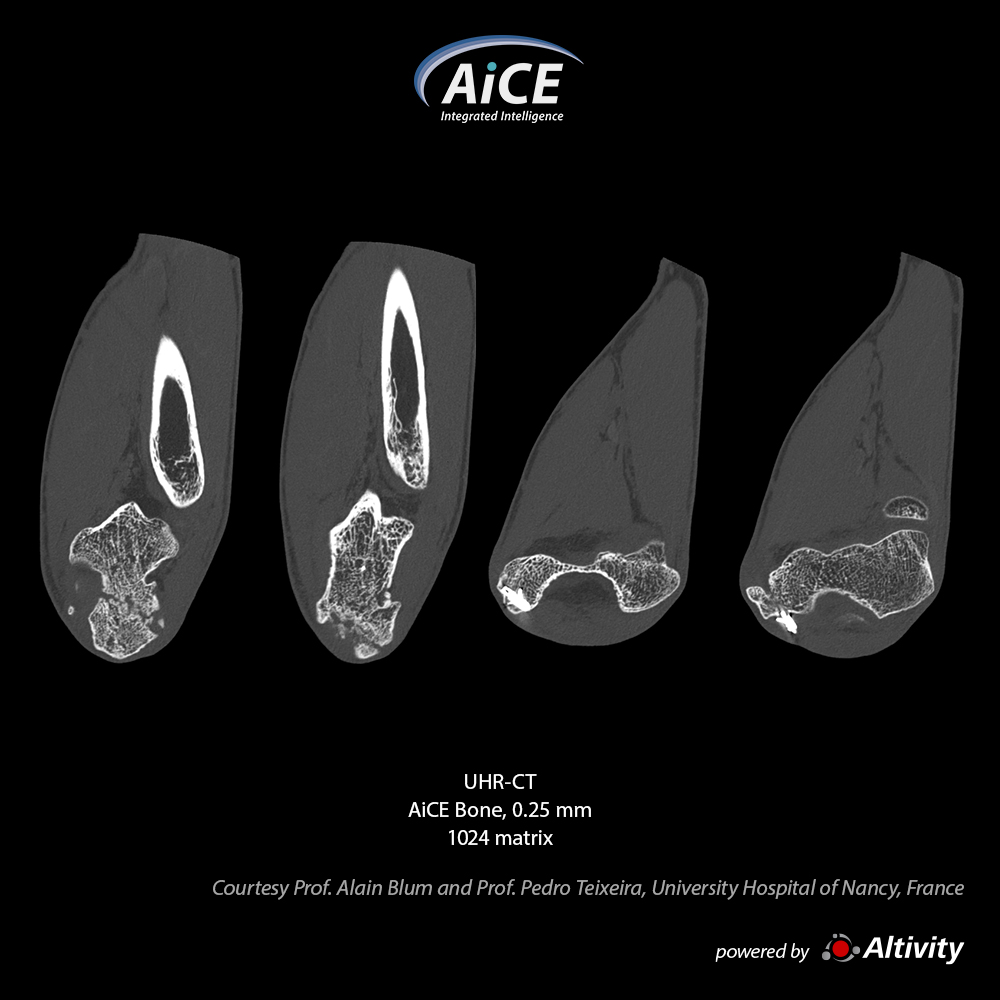 Aquilion Precision Elbow
