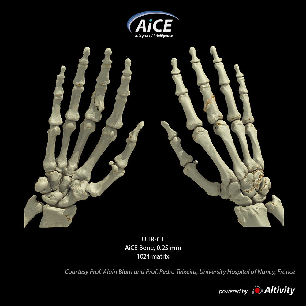 Aquilion Precision Finger