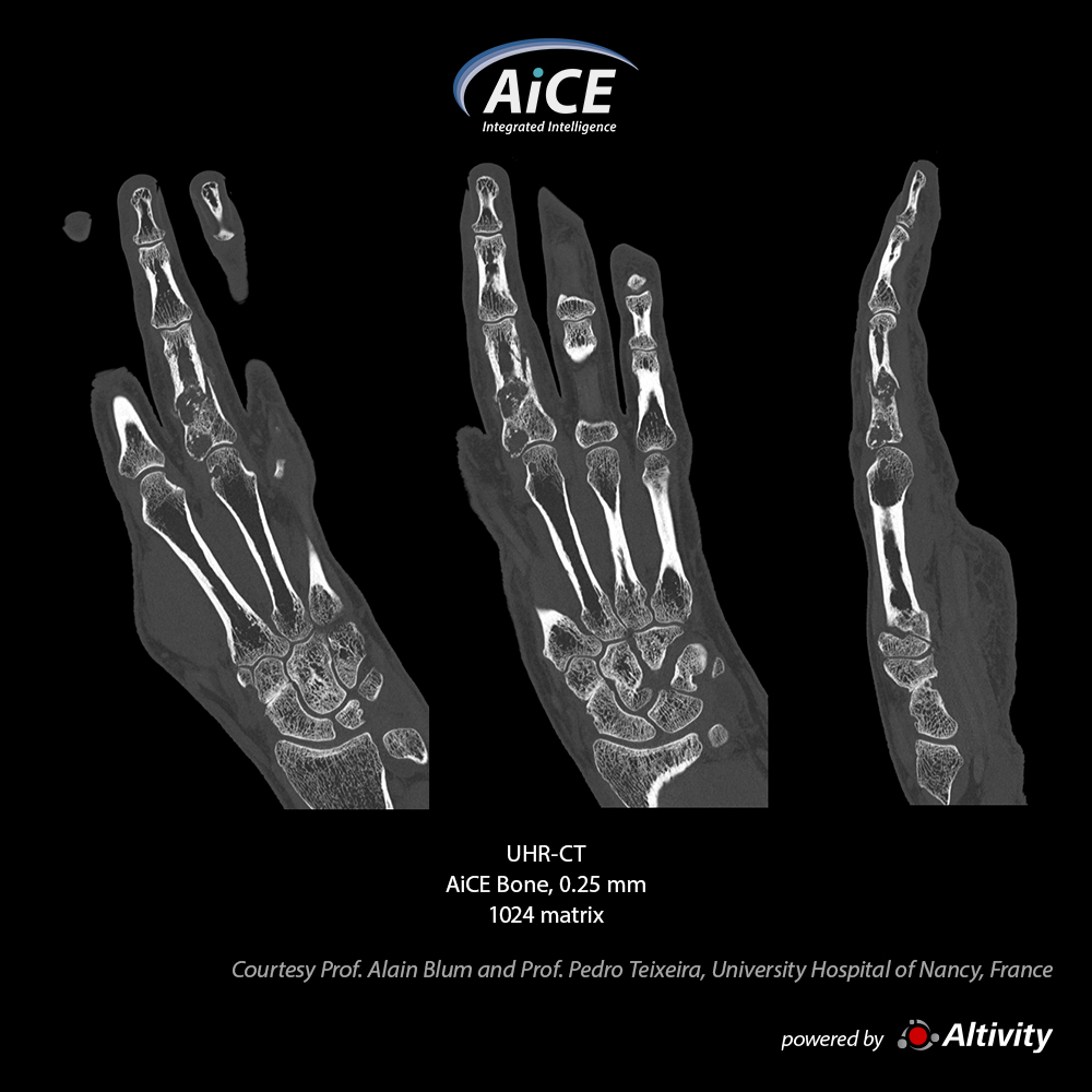 Aquilion Precision Finger