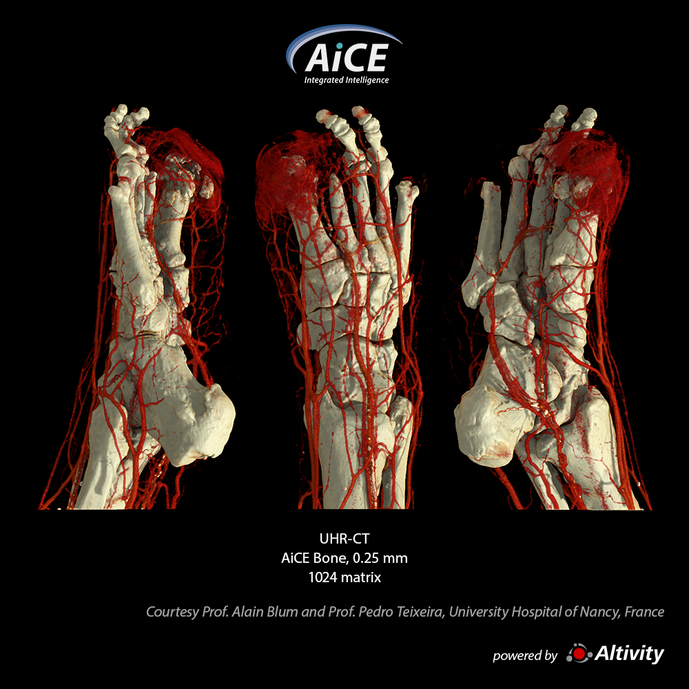 Aquilion Precision Foot
