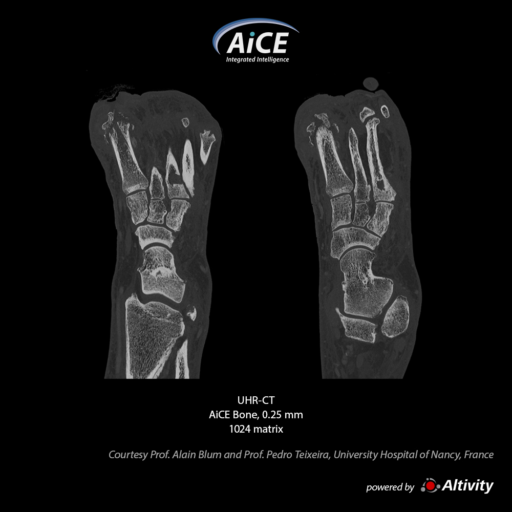 Aquilion Precision Foot