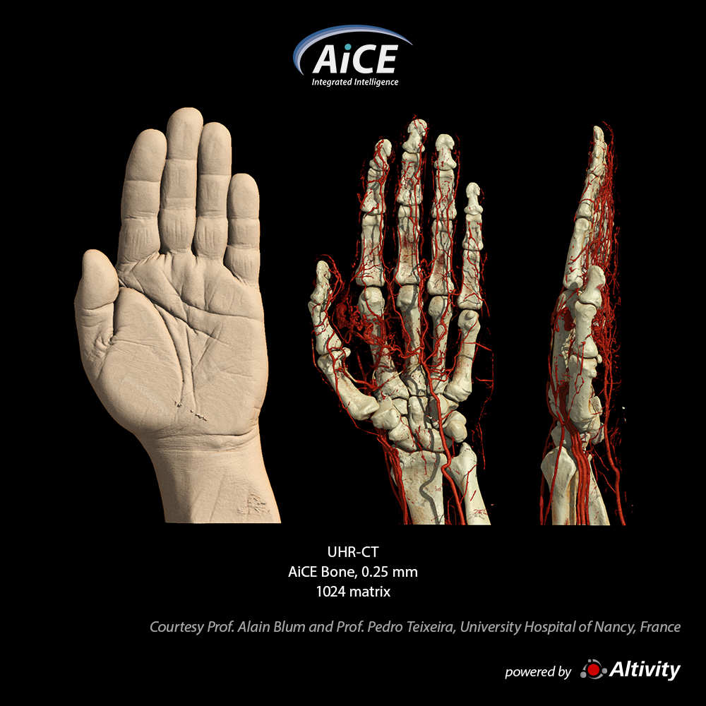 Aquilion Precision Hand