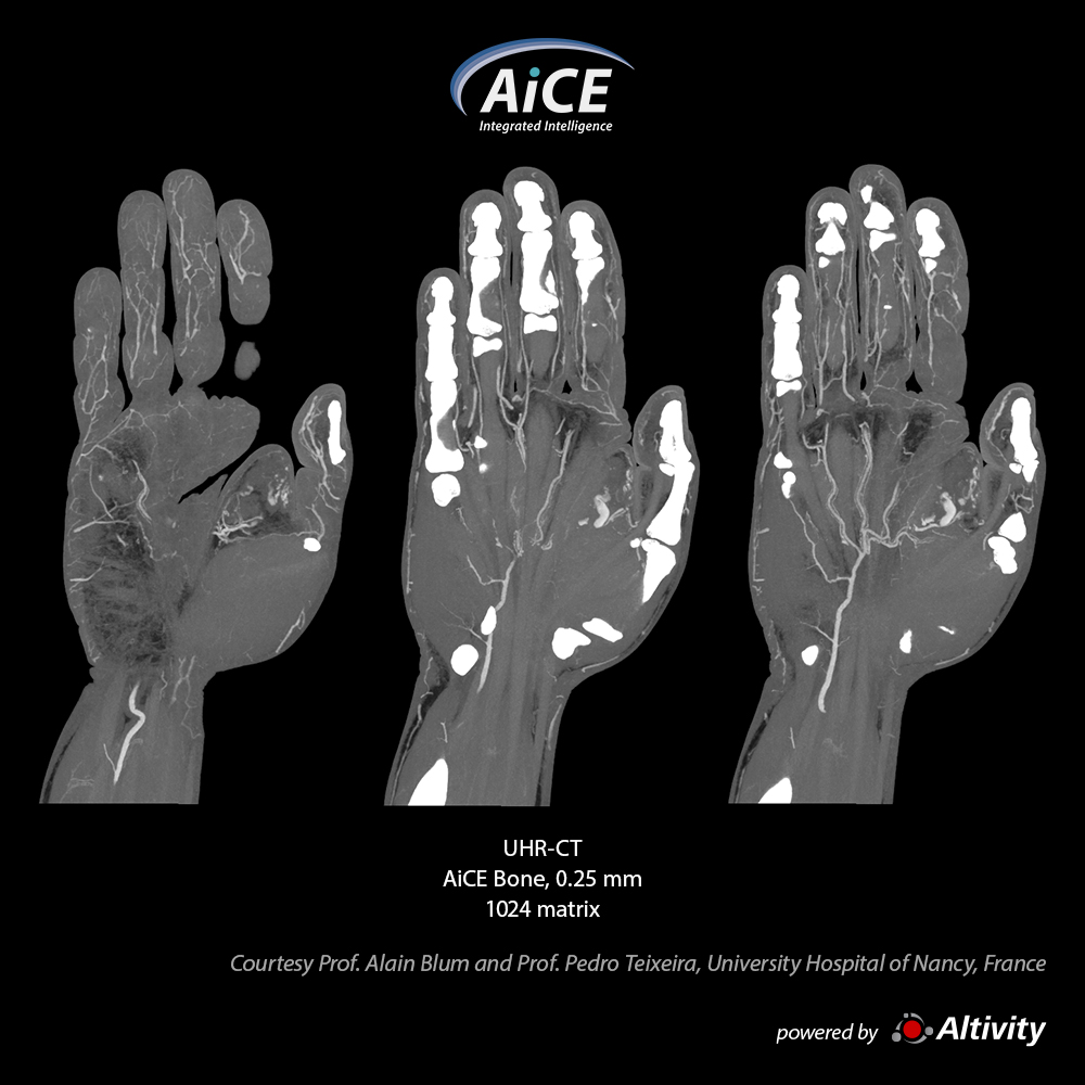 Aquilion Precision Hand