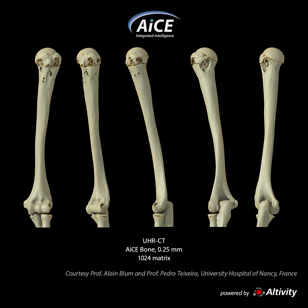 Aquilion Precision Humerus-tumor