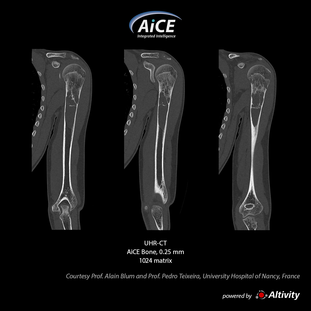 Aquilion Precision Humerus-tumor