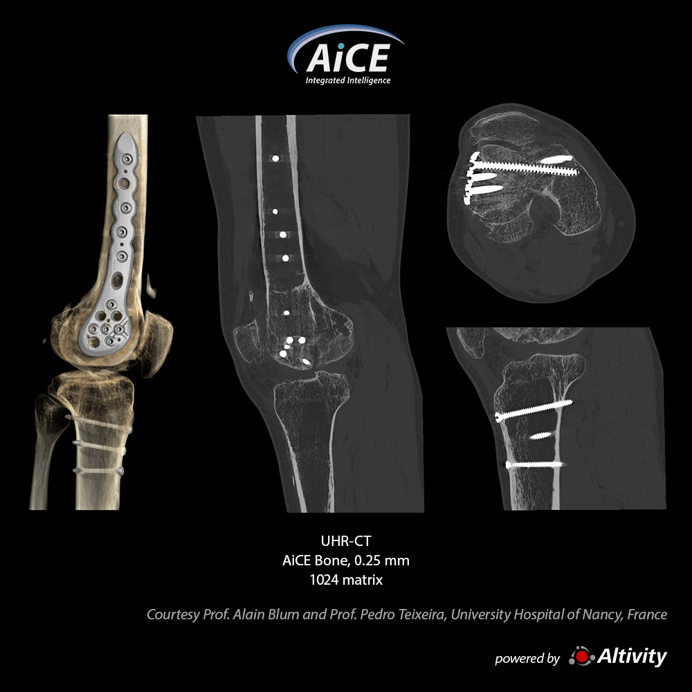 Aquilion Precision Knee-SEMAR