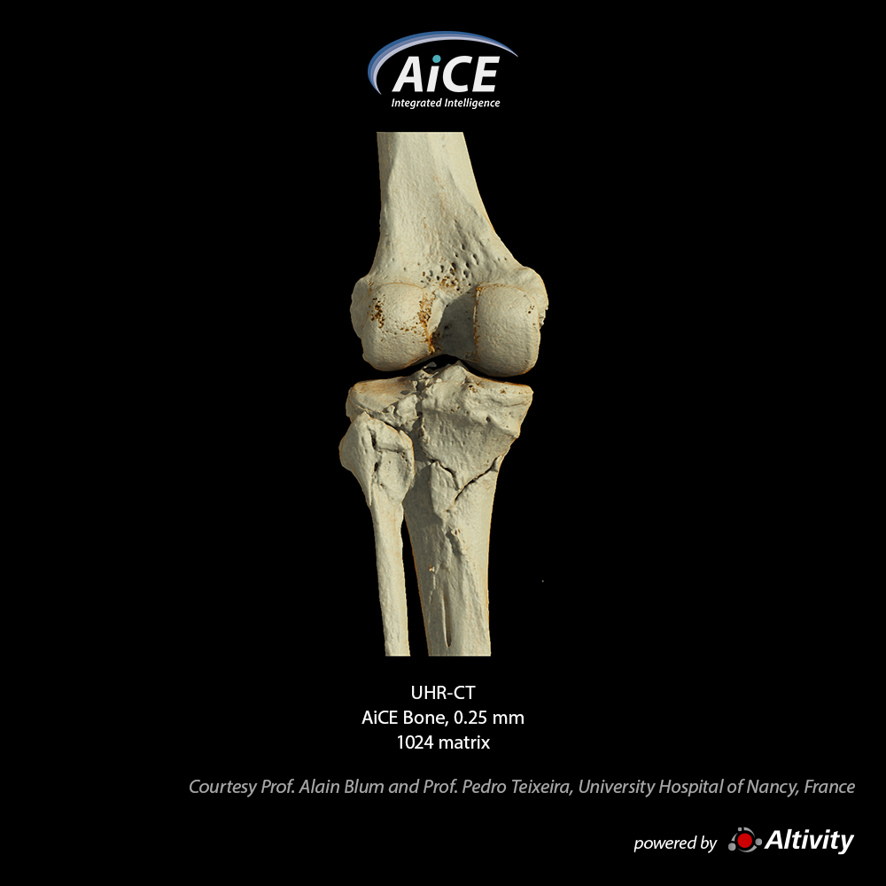 Aquilion Precision Knee