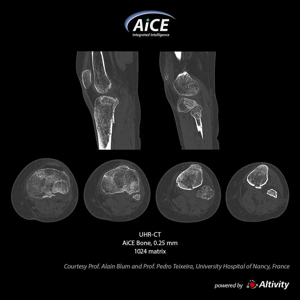 Aquilion Precision Knee