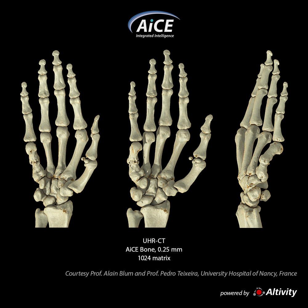 Aquilion Precision Metacarpal