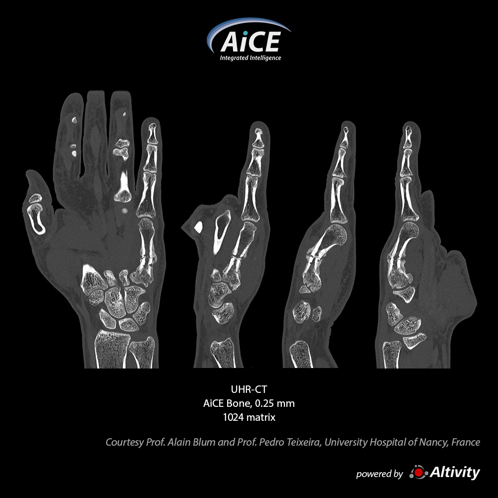 Aquilion Precision Metacarpal