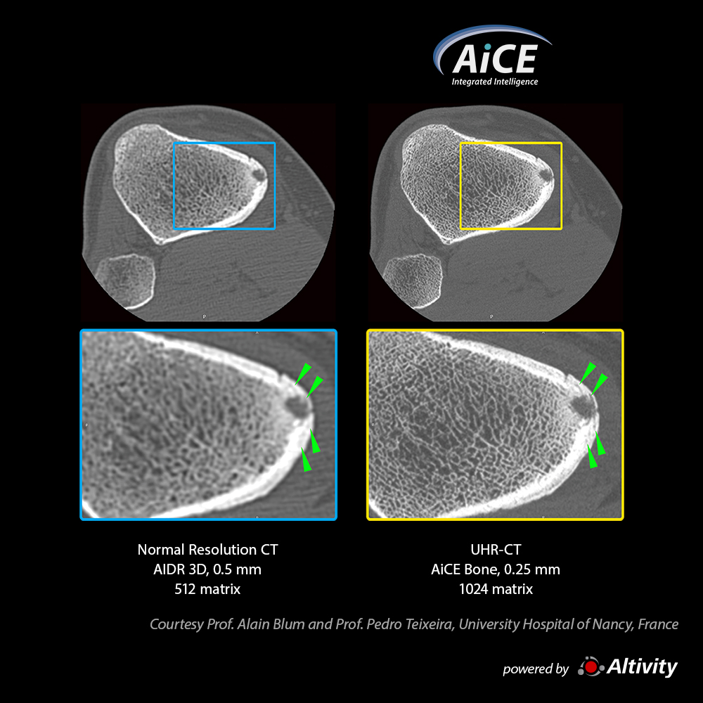 Aquilion Precision Musculoskeletal 1