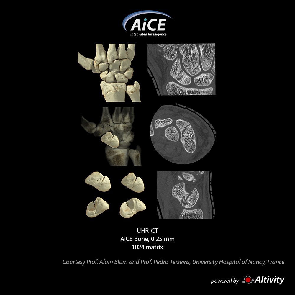 Aquilion Precision Scaphoid