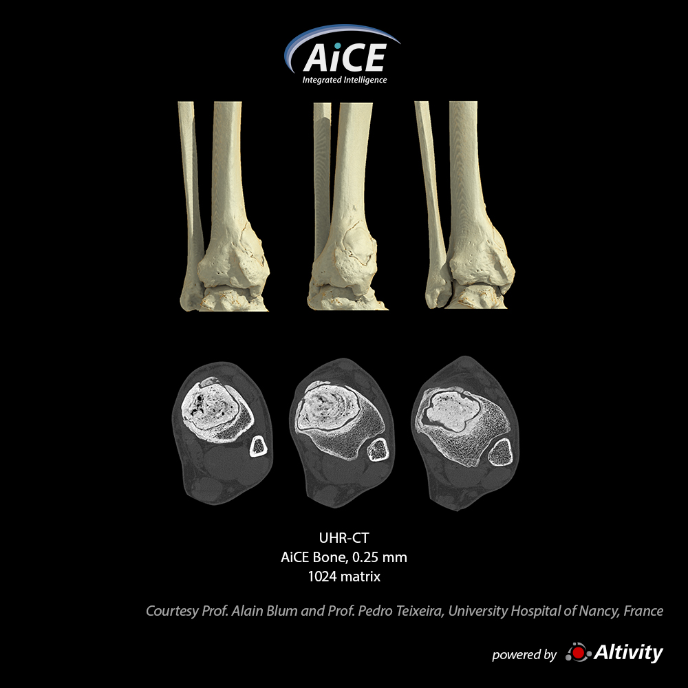 Aquilion Precision Tibia-tumor