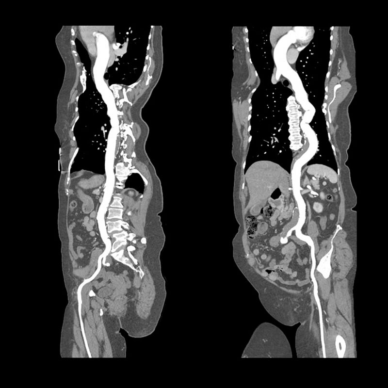 Aquilion Prime SP Aorta Severe Atherosclerosis