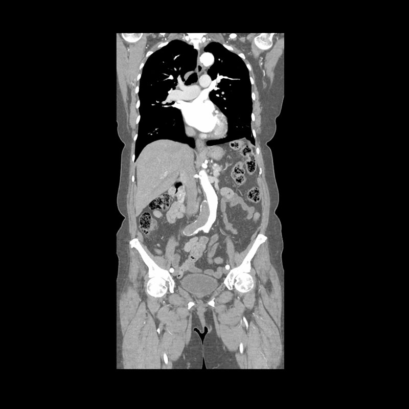 Aquilion Prime SP Aorta Severe Atherosclerosis