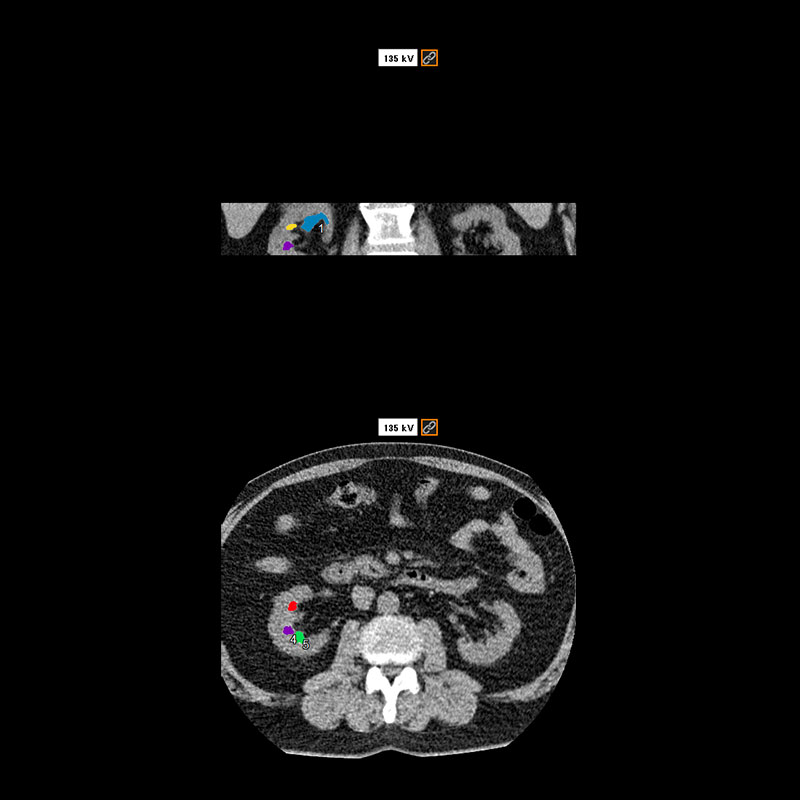 Aquilion Prime SP Kidney Stones DE