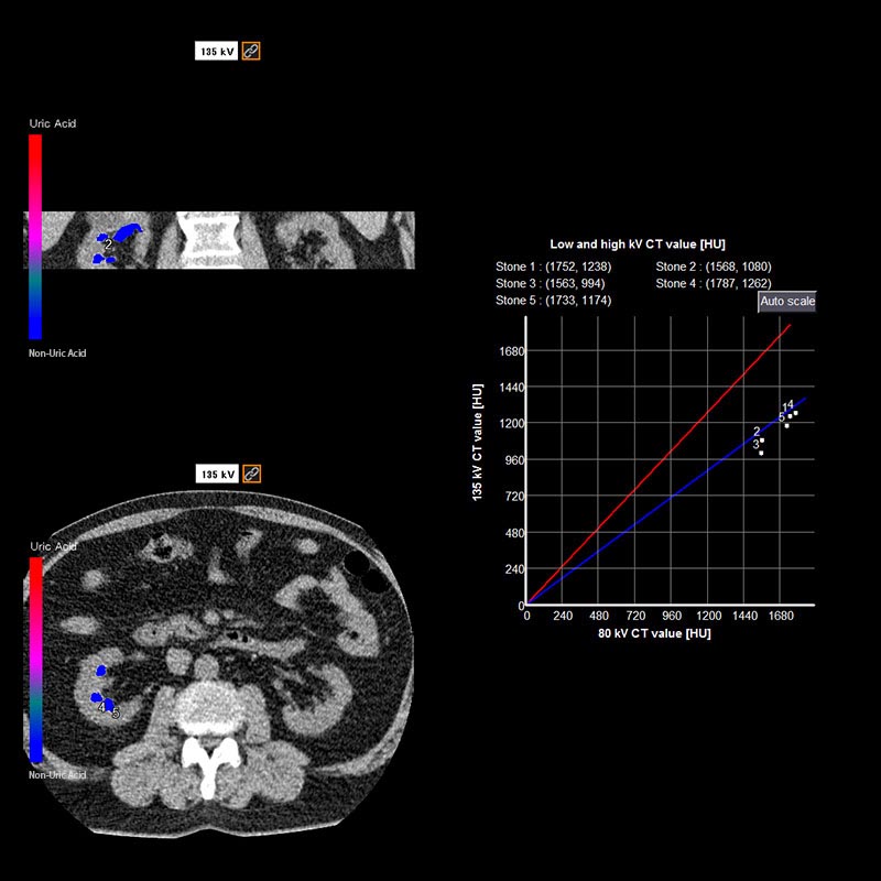 Aquilion Prime SP Kidney Stones DE