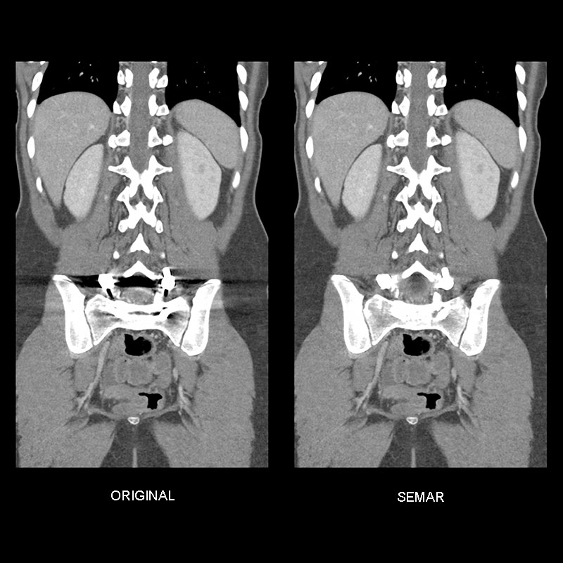 Aquilion Prime SP Lumbar Spine Fixation