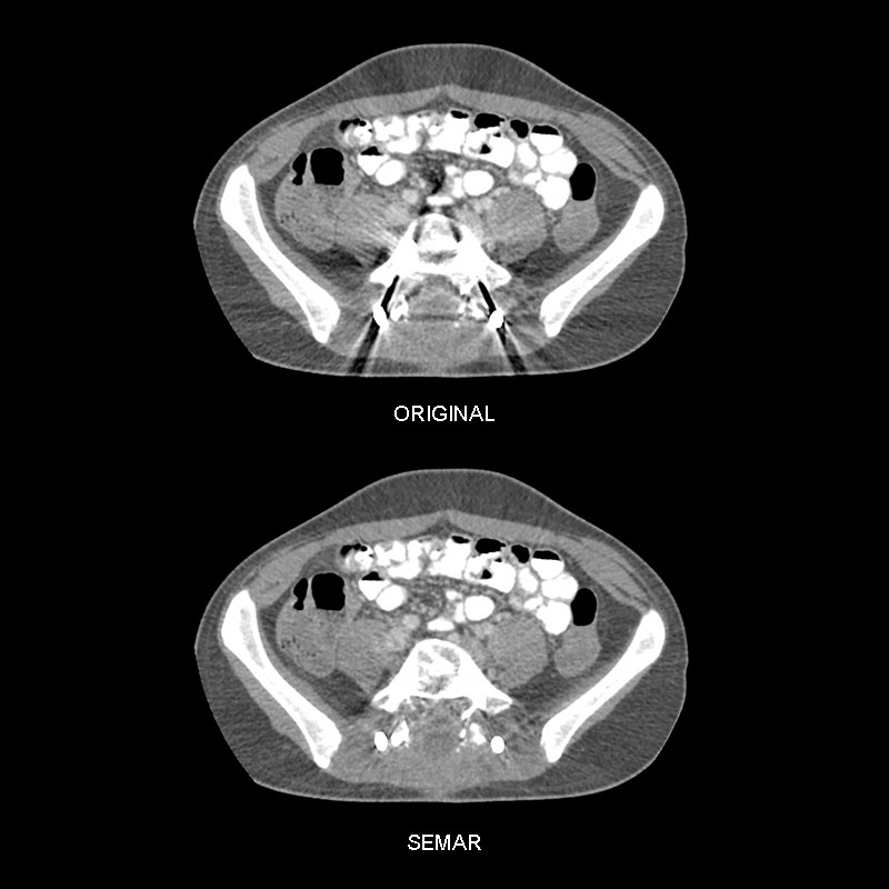 Aquilion Prime SP Lumbar Spine Fixation
