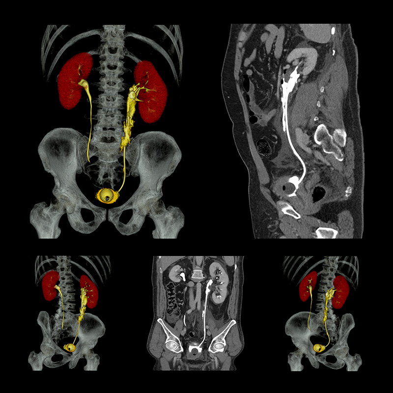 Aquilion Prime SP Kidney Lt. Ureteral Leak