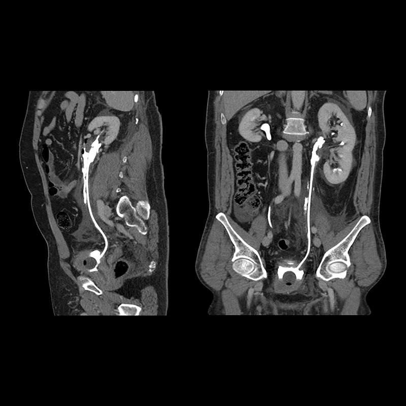 Aquilion Prime SP Kidney Lt. Ureteral Leak