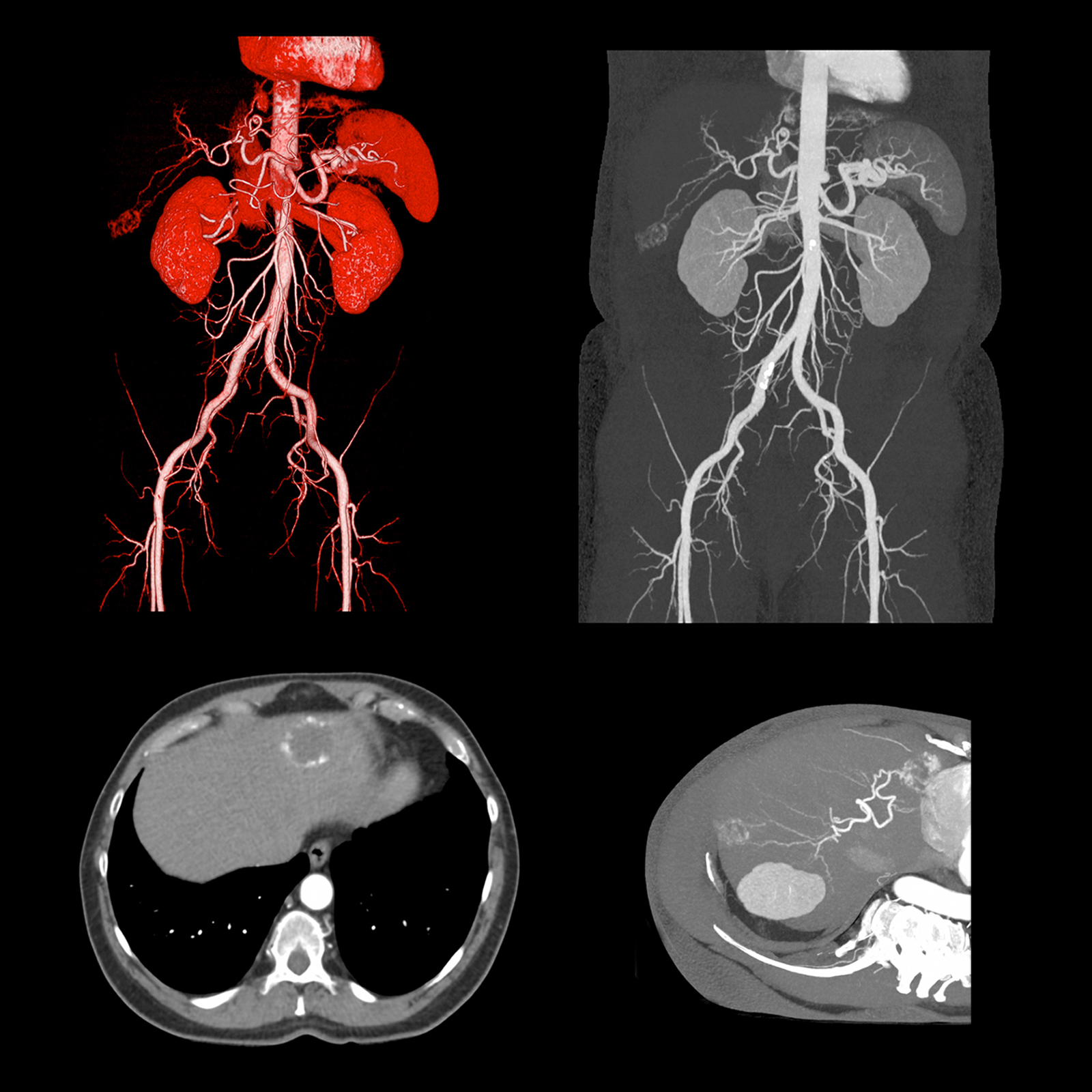 Aquilion Prime SP Aorta CTA Liver Tumor Feeding Arteries