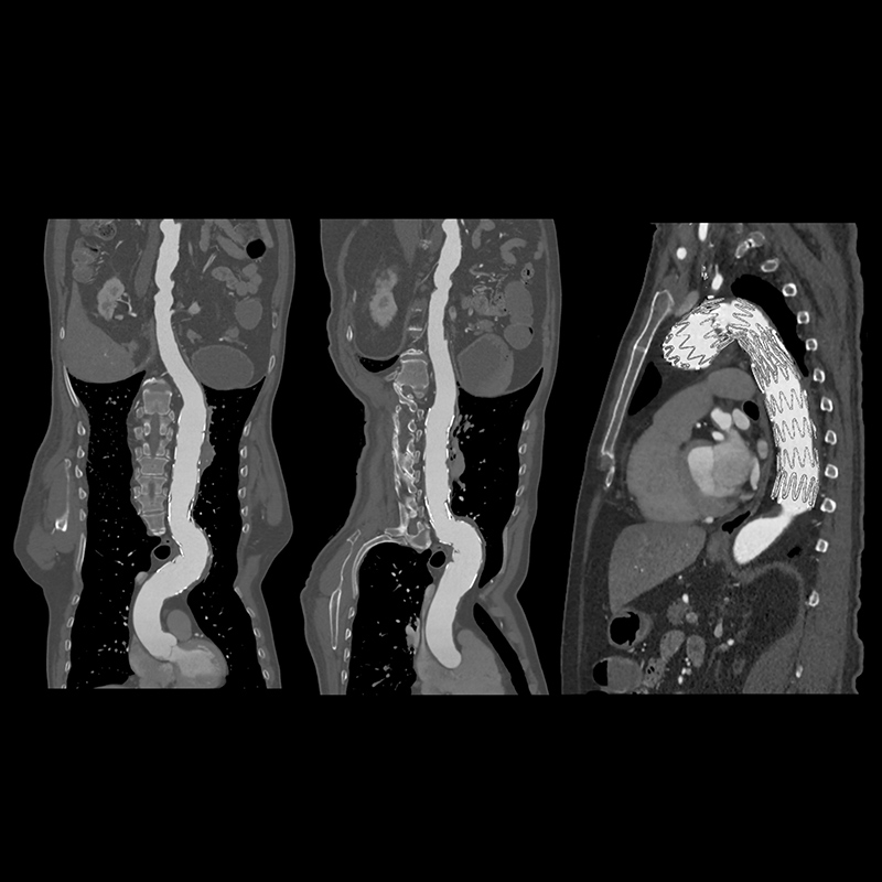 Aquilion Prime SP Aorta vHP - Aortic Stent Graft