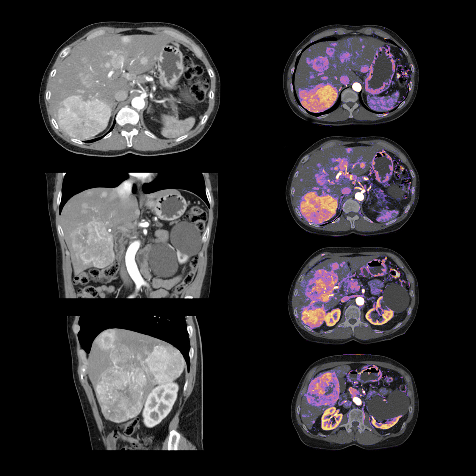 Aquilion Prime SP Liver Iodine Mapping Masses