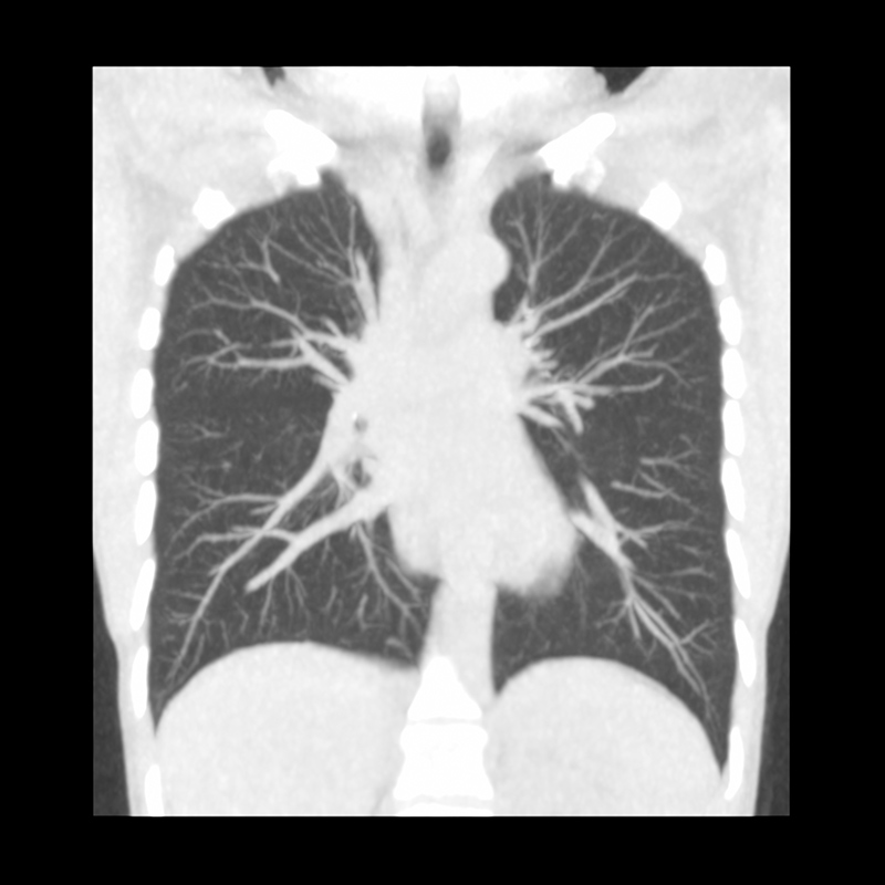 Aquilion Prime SP Lung Ultra-Low Dose