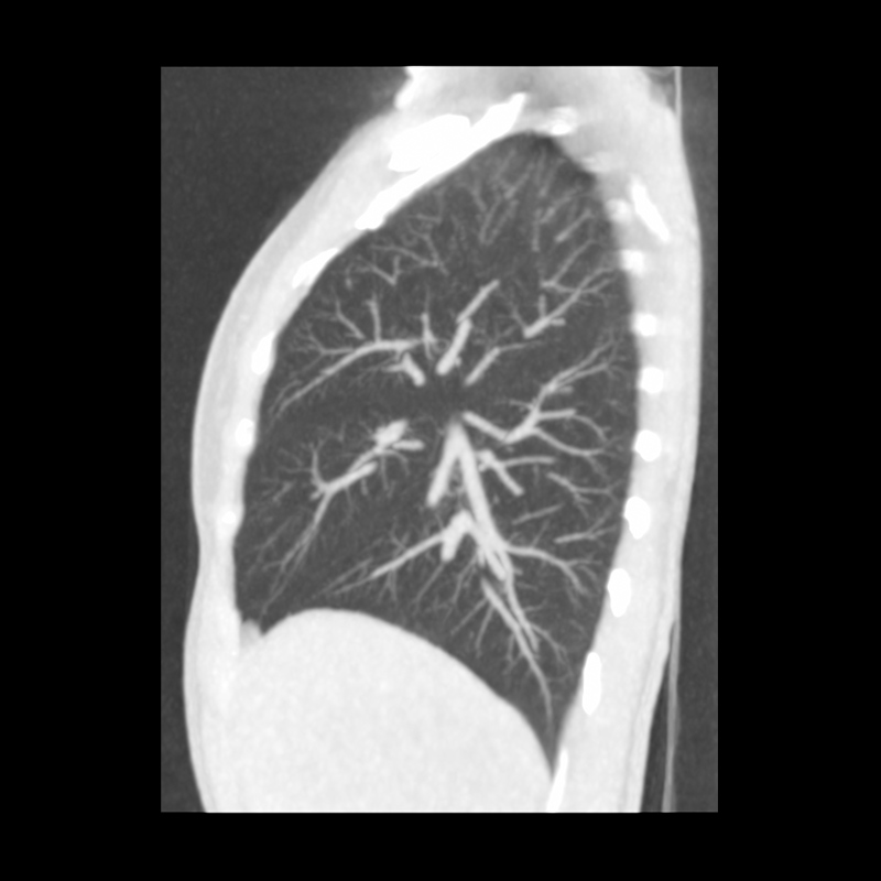 Aquilion Prime SP Lung Ultra-Low Dose