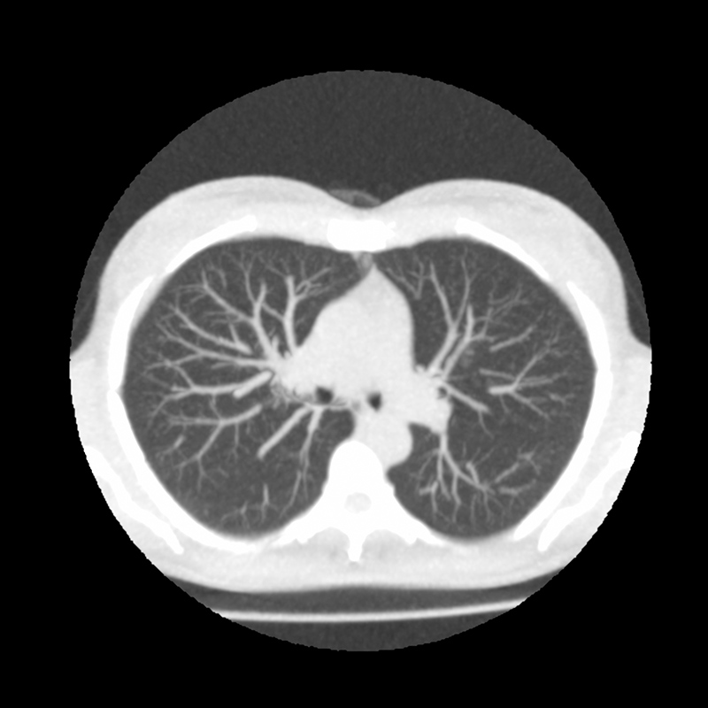 Aquilion Prime SP Lung Ultra-Low Dose