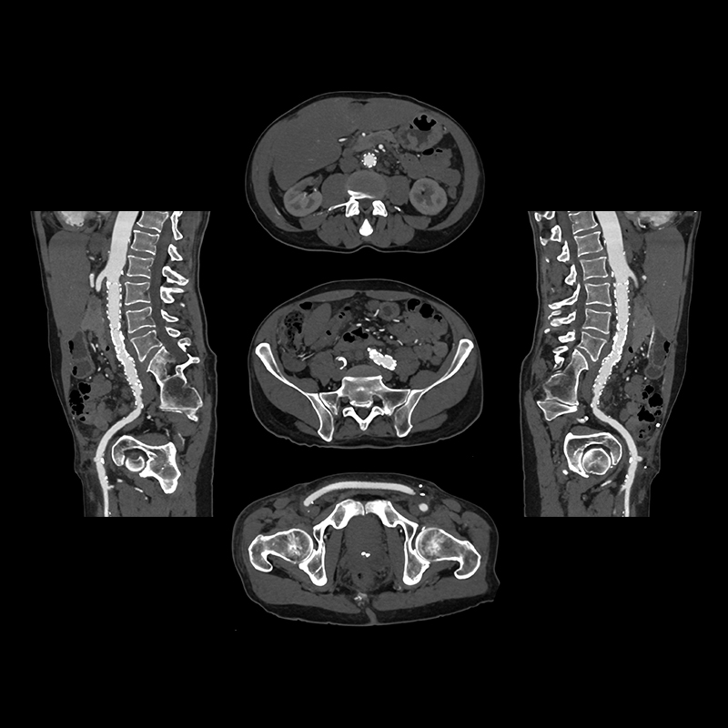 Aquilion Prime SP Abdomen Pelvis CTA, Endograft, AiCE