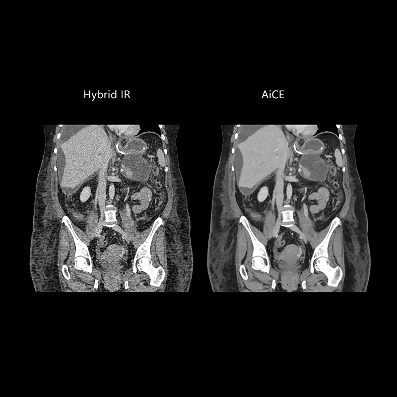 Aquilion Prime SP Abdomen Pelvis, Large Patient, AiCE