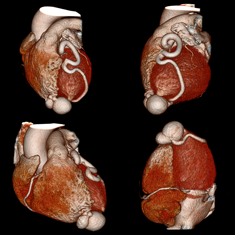 Aquilion Prime SP Cardiac CTA Coronary Artery Fistula