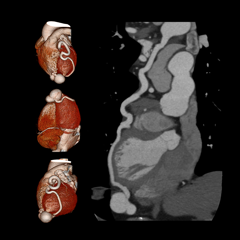 Aquilion Prime SP Cardiac CTA Coronary Artery Fistula