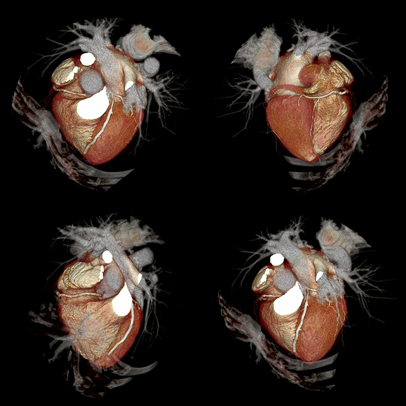Aquilion Prime SP Cardiac CTA LAD Stents, RCA Mixed-Plaques