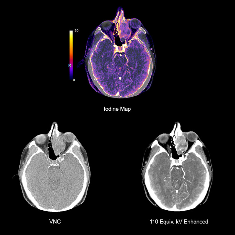 Aquilion Prime SP Sinus DE Adenocarcinoma