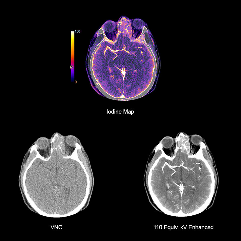 Aquilion Prime SP Sinus DE Adenocarcinoma