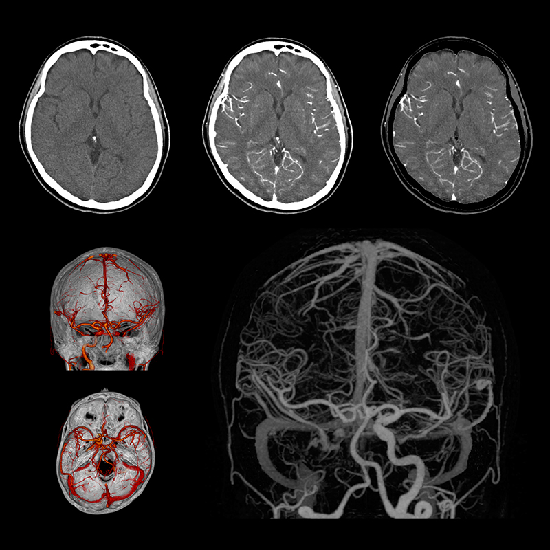 Aquilion Prime SP Brain CTA SURESubtraction Rt. ICA Occlusion
