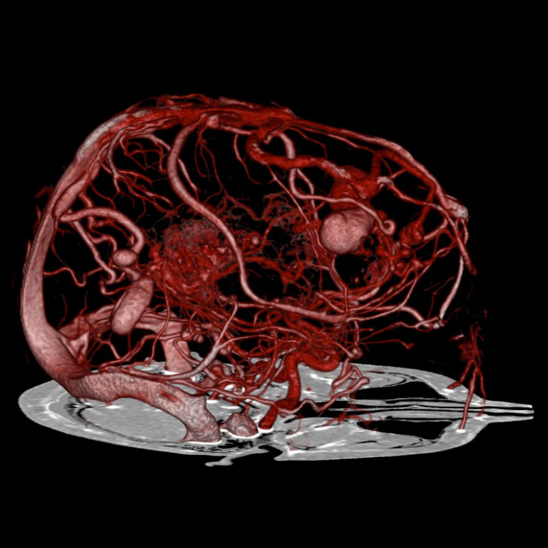 Aquilion Prime SP Brain CTA SURESubtraction aneurysms and AVMs