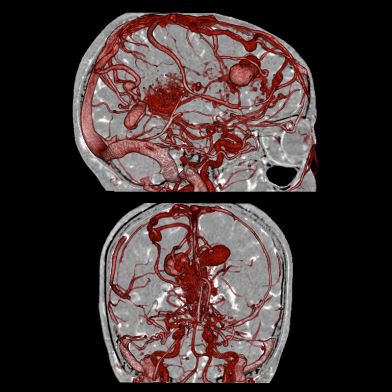 Aquilion Prime SP Brain CTA SURESubtraction aneurysms and AVMs