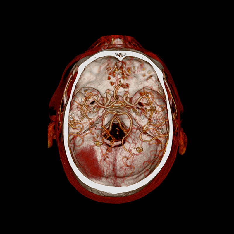 Aquilion Prime SP Brain Hemorrhage