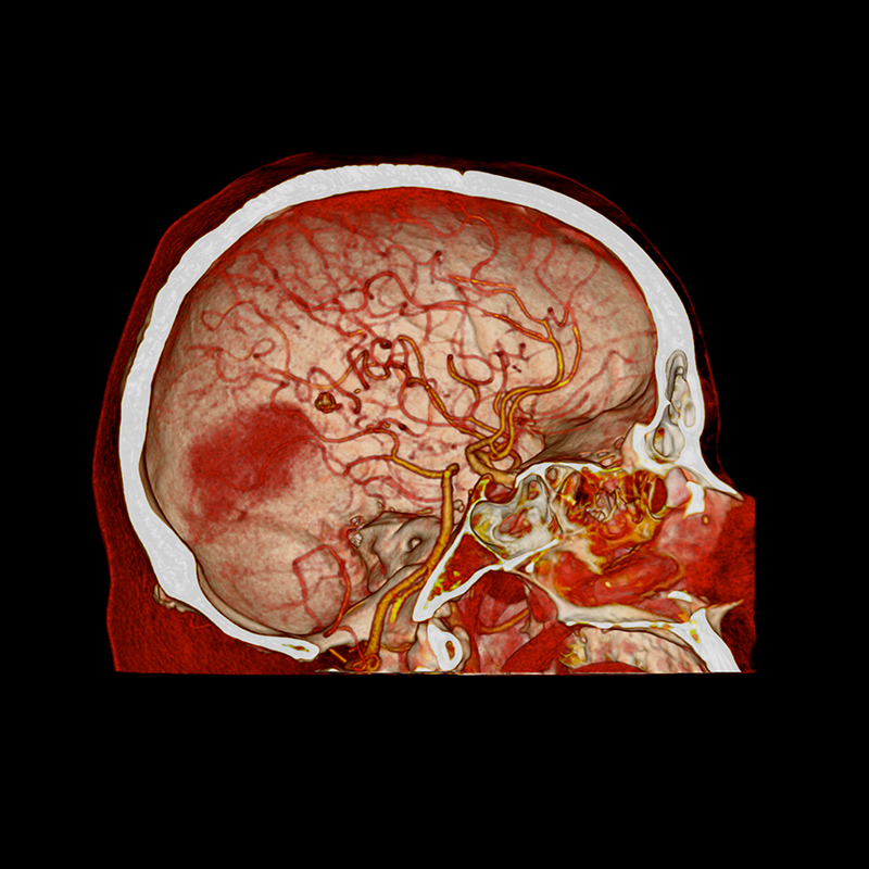 Aquilion Prime SP Brain Hemorrhage