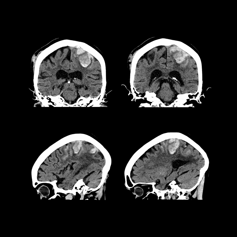 Aquilion Prime SP Brain, AiCE LCD