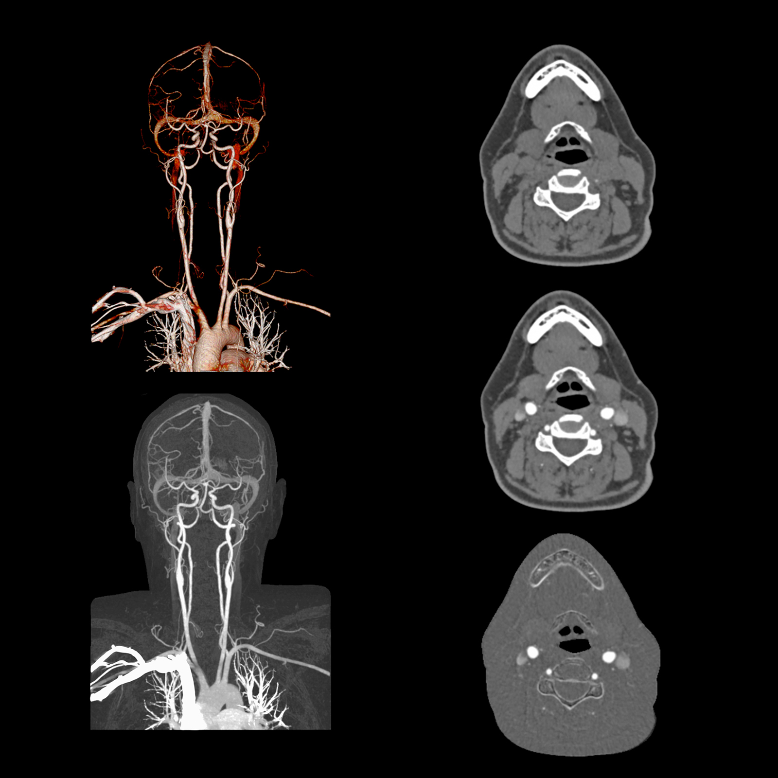 Aquilion Prime SP SURESubtraction, Carotid CTA