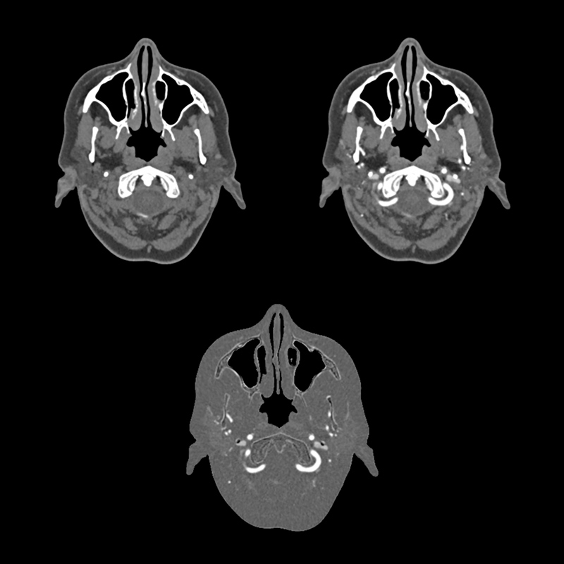 Aquilion Prime SP SURESubtraction, Carotid CTA