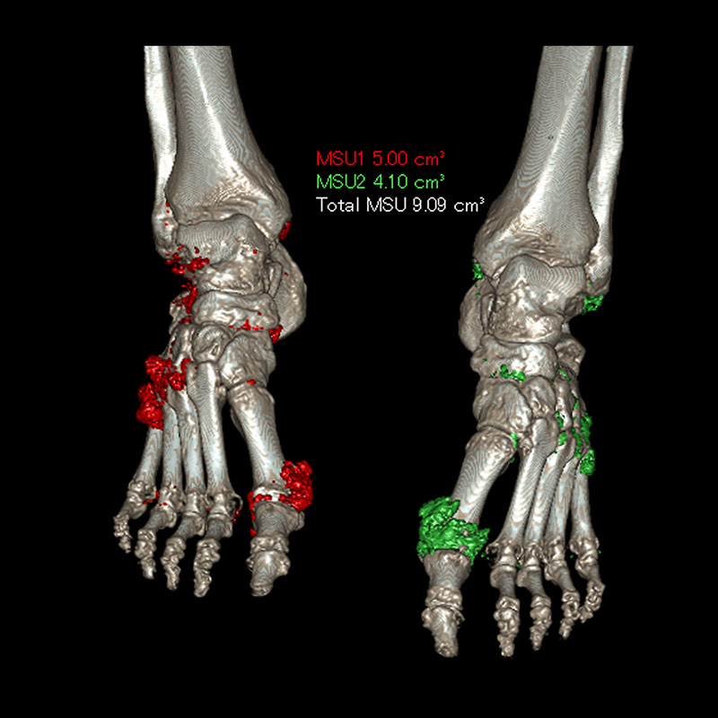 Aquilion Prime SP Feet DE Composition Analysis